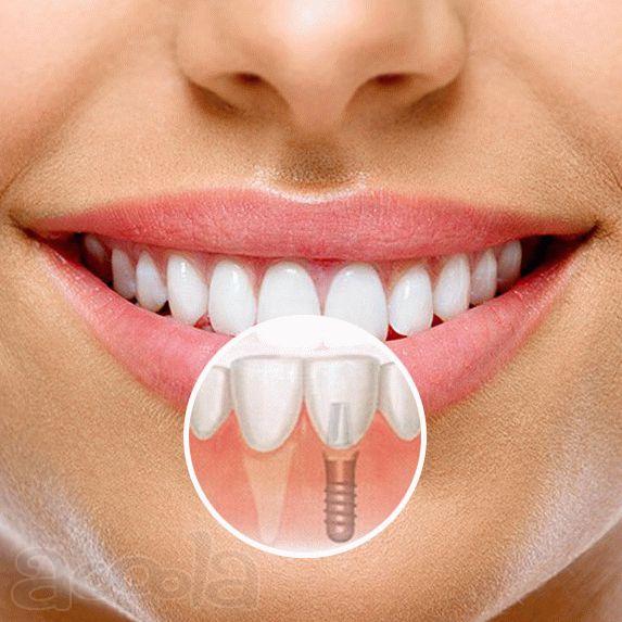 Имплантация зубов в июле