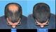 Загуститель для волос CABOKE маскирует редкие волосы в густую шевелюру всего за 1 минуту